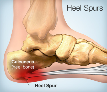 Home remedies for Heel Spurs