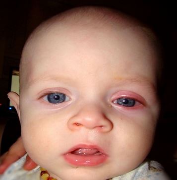 Home remedies for pink eye in toddlers