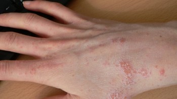 Scabies is caused by mite; sarcoptes scabiei