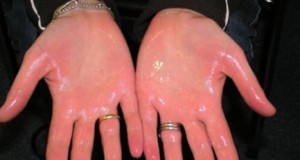 excessive sweating on hands